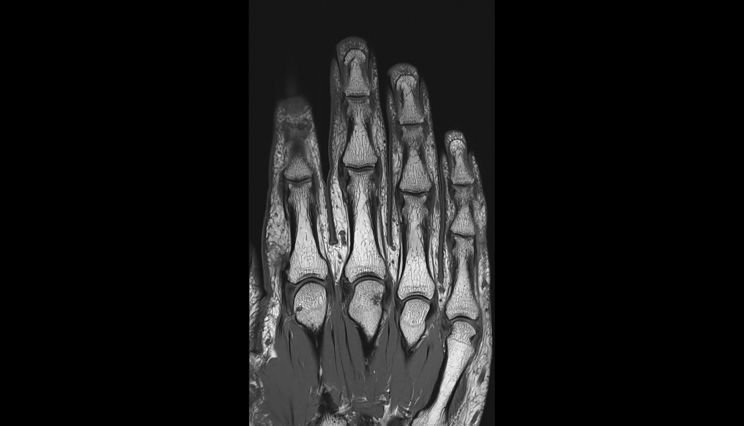 Body of proximal phalanx  MRI CORONAL image-img-00000-00000