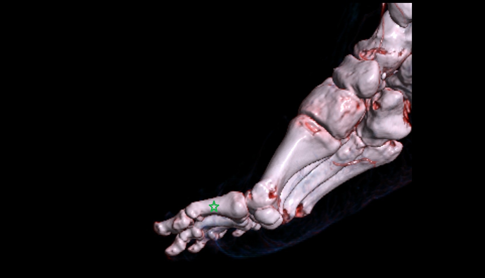 Body of proximal phalanx of great toe