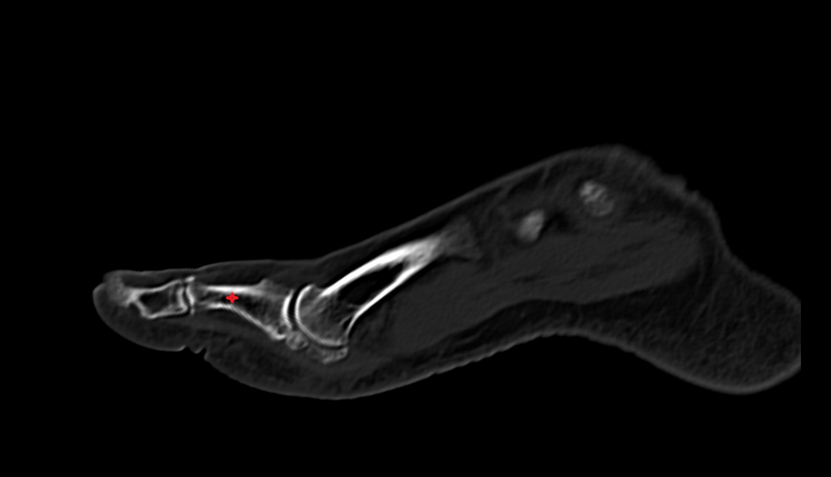 Body of proximal phalanx of great toe ct