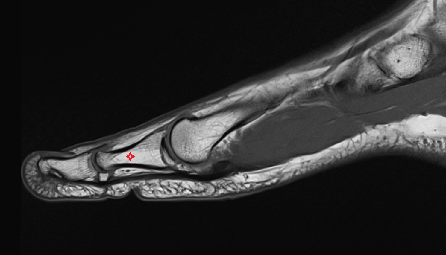 Body of proximal phalanx of great toe mri  anatomy labelled image-img-00000-00000