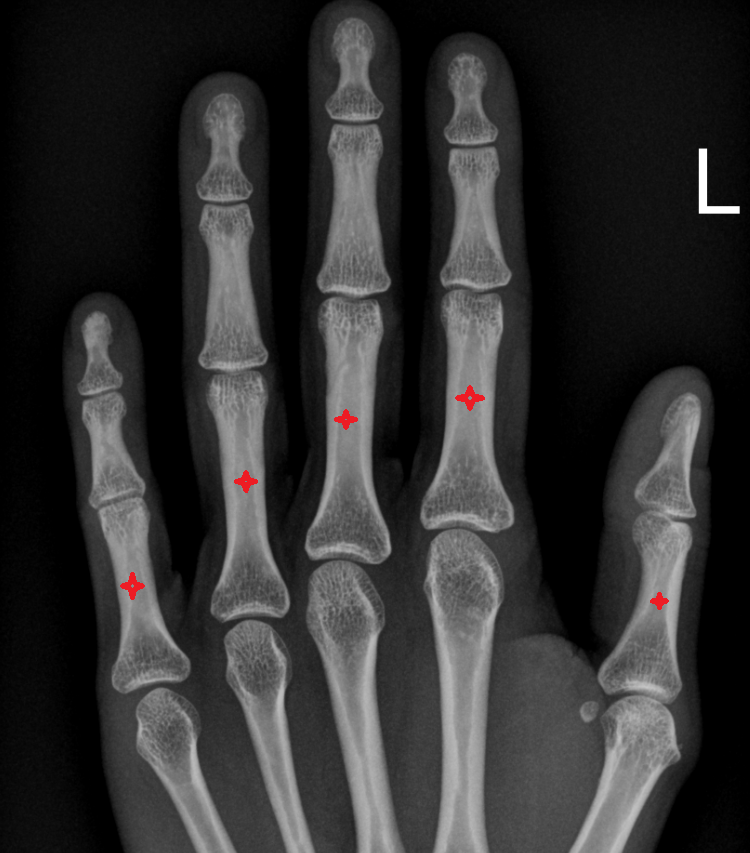 Body of proximal phalanx x ray  anatomy labelled image-img-00000-00000