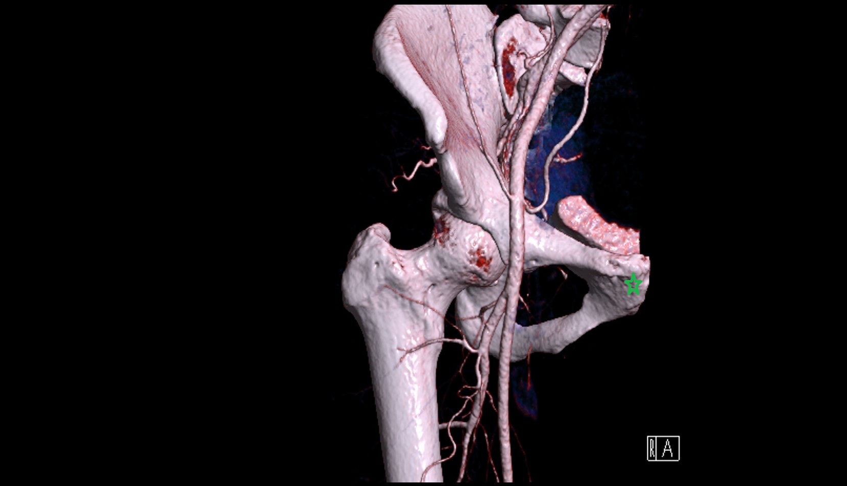 Body of pubis 3d IMAGE