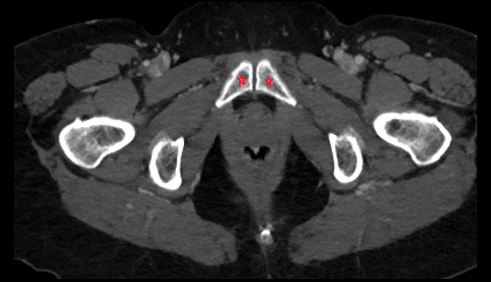 Body of pubis CT axial image