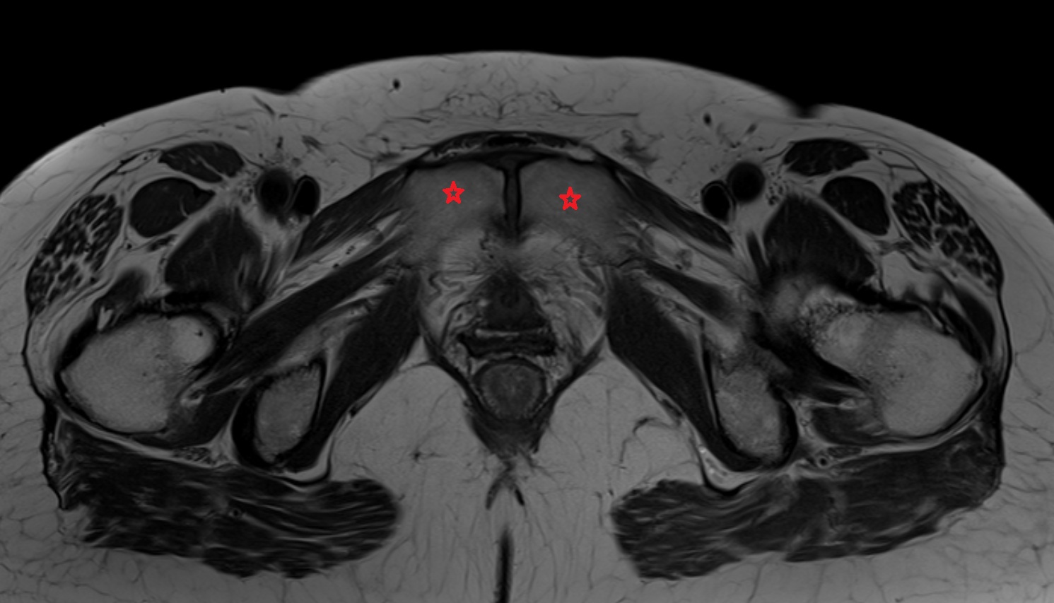 Body of pubis  MRI  axial  anatomy  image-img-00000-00000
