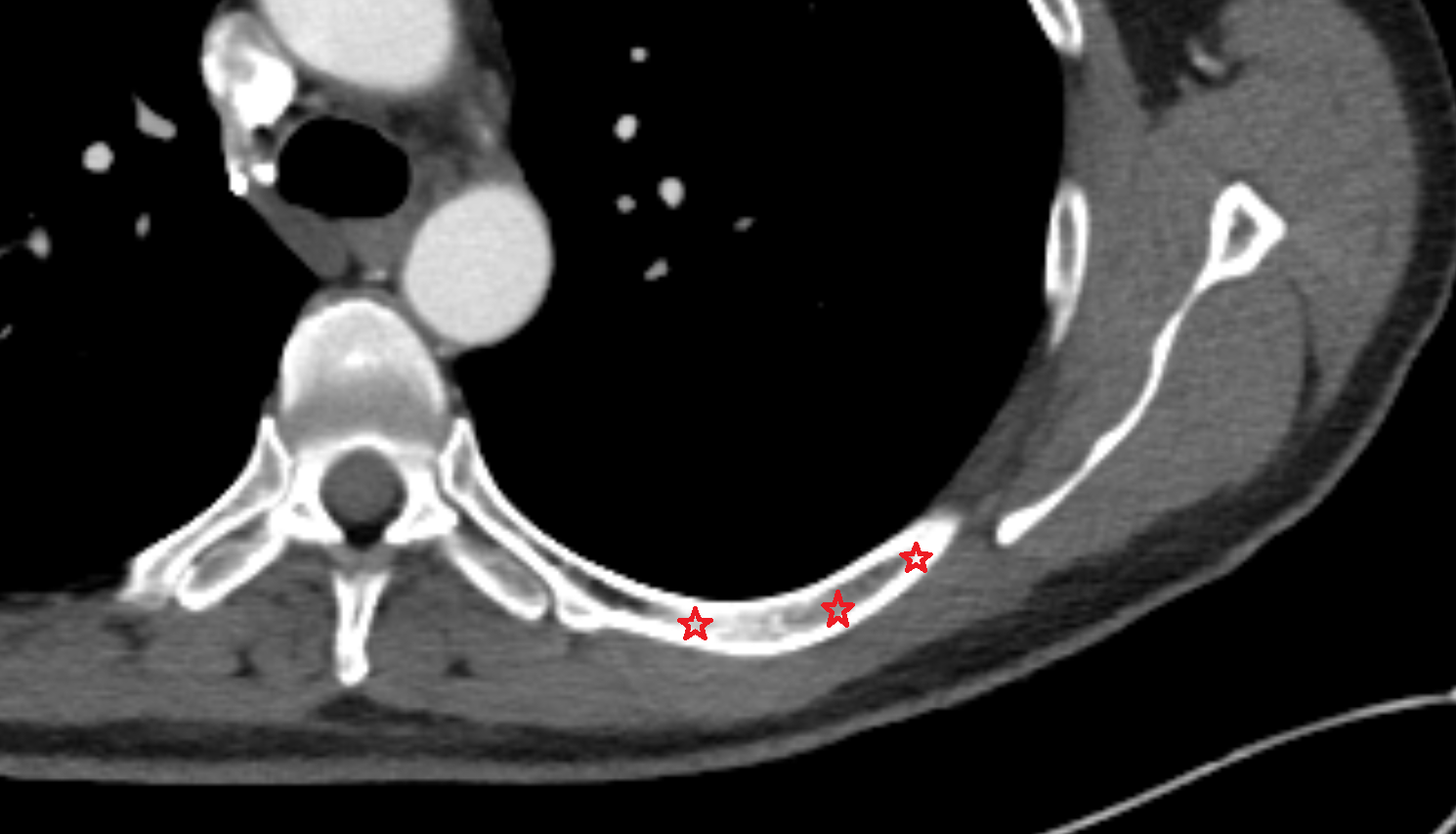Body of rib CT Anatomy, Location and Imaging Appearance  -img-00000-00000