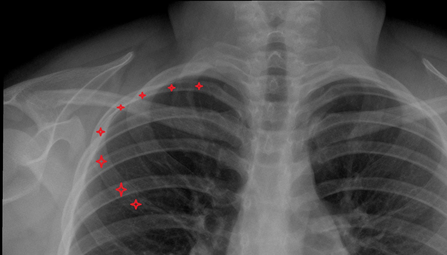 Body of rib X ray Anatomy, Location and Imaging Appearance  -img-00000-00000