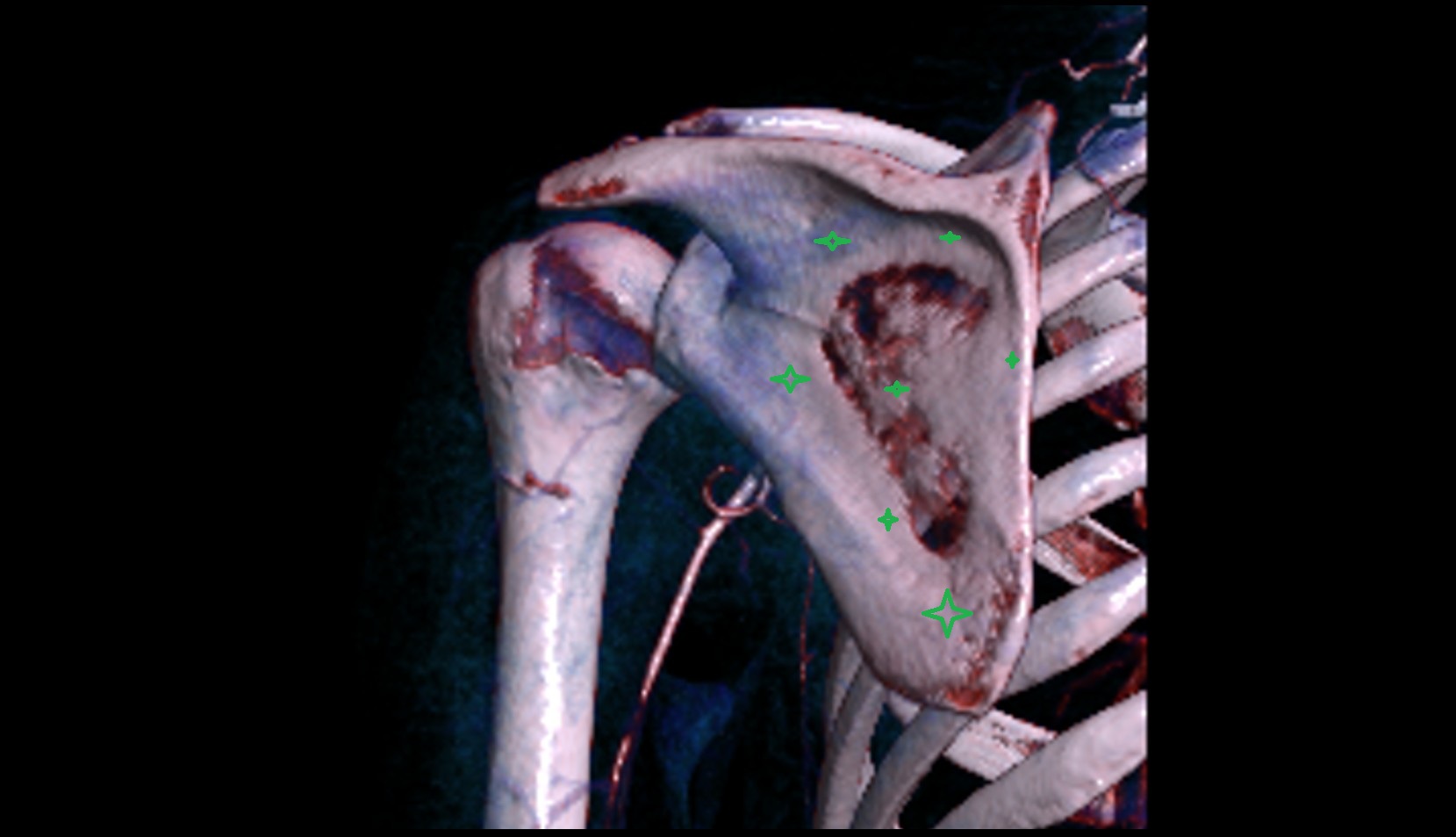Body of scapula 3d vrt image