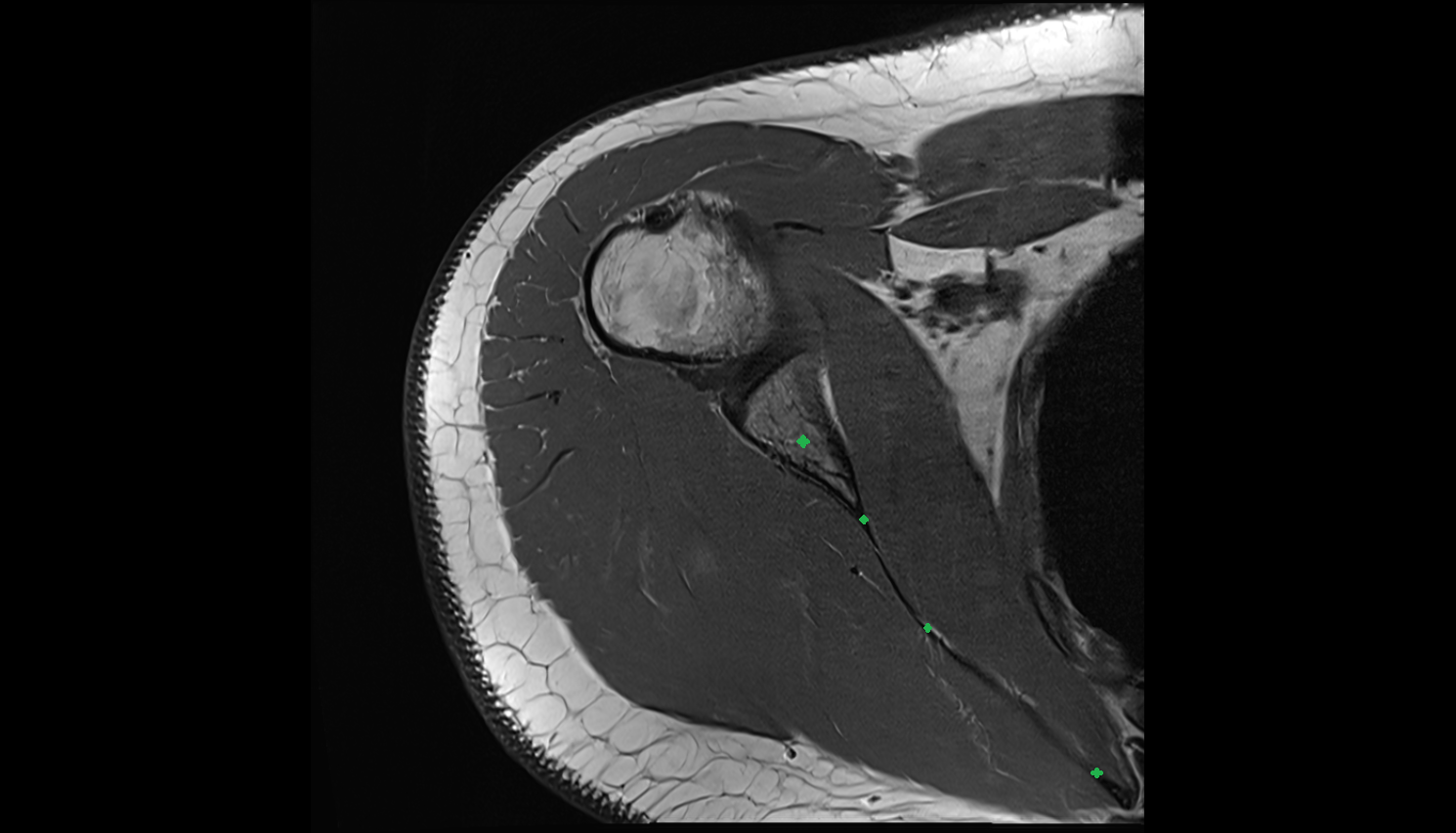 Body of scapula axial cross sectional anatomy 3T MRI AI enhanced radiology image-img-00000-00000