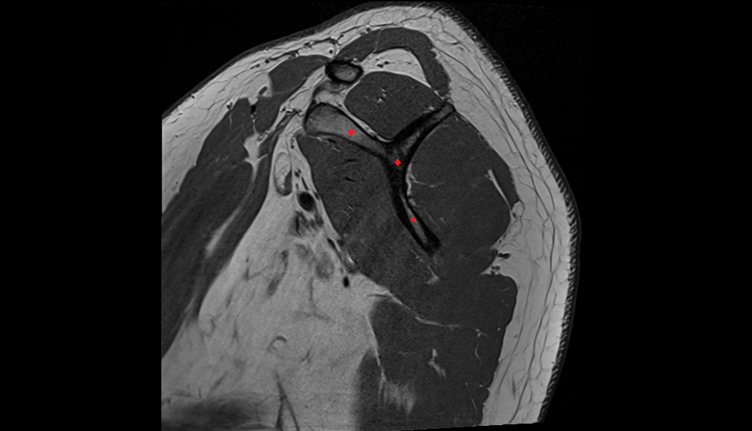 Body of scapula coronal cross sectional anatomy 3T MRI AI enhanced radiology image-img-00000-00000