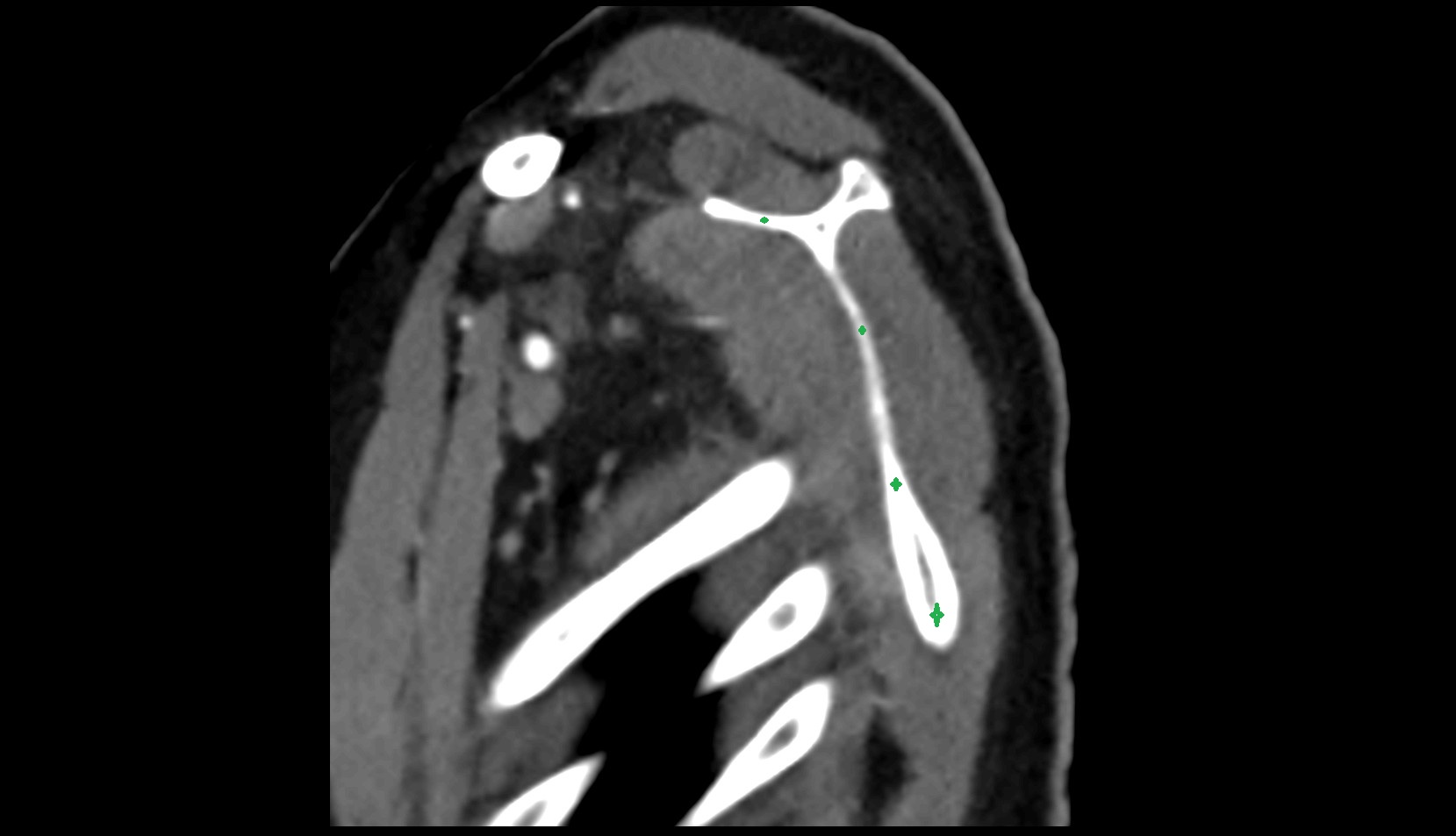 Body of scapula ct sag