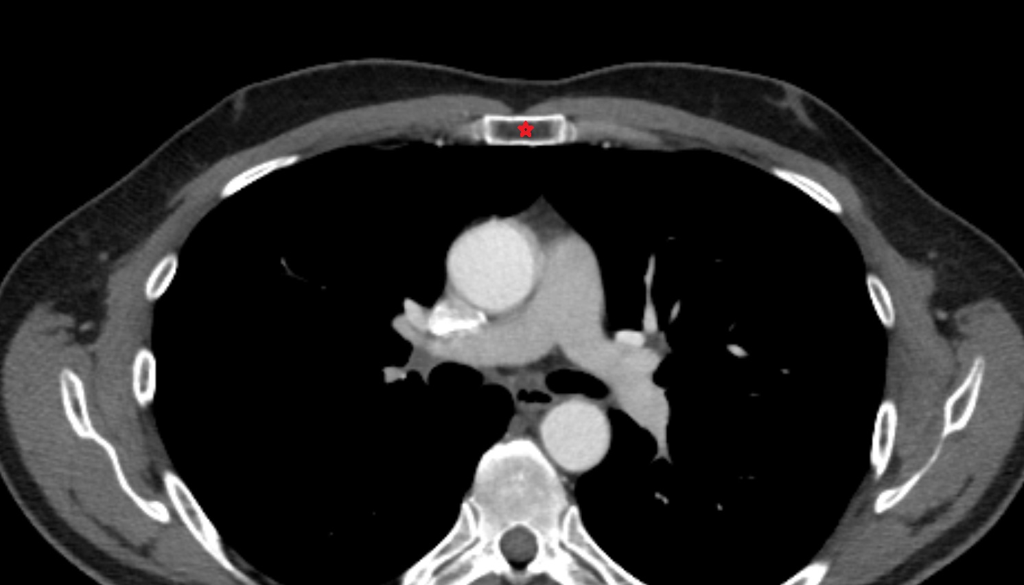 Body of sternum CT axial  image -img-00000-00000