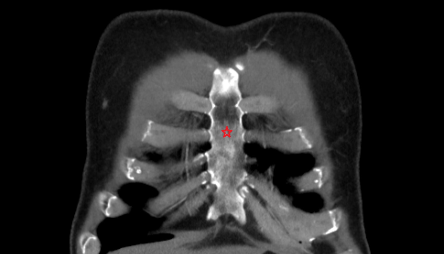 Body of sternum CT coronal  image -img-00000-00000