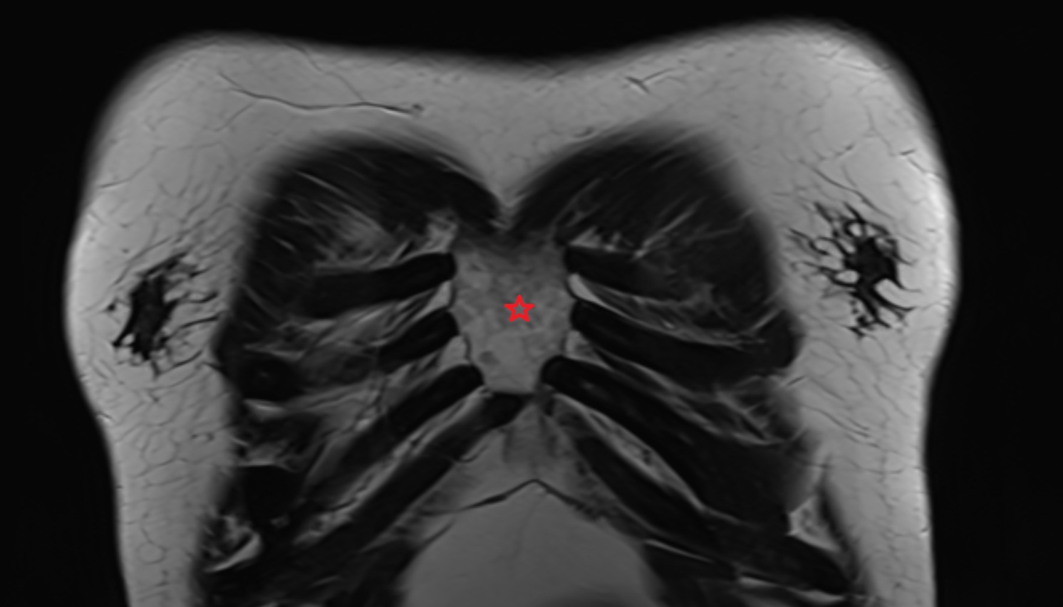Body of sternum MRI coronal  image -img-00000-00000