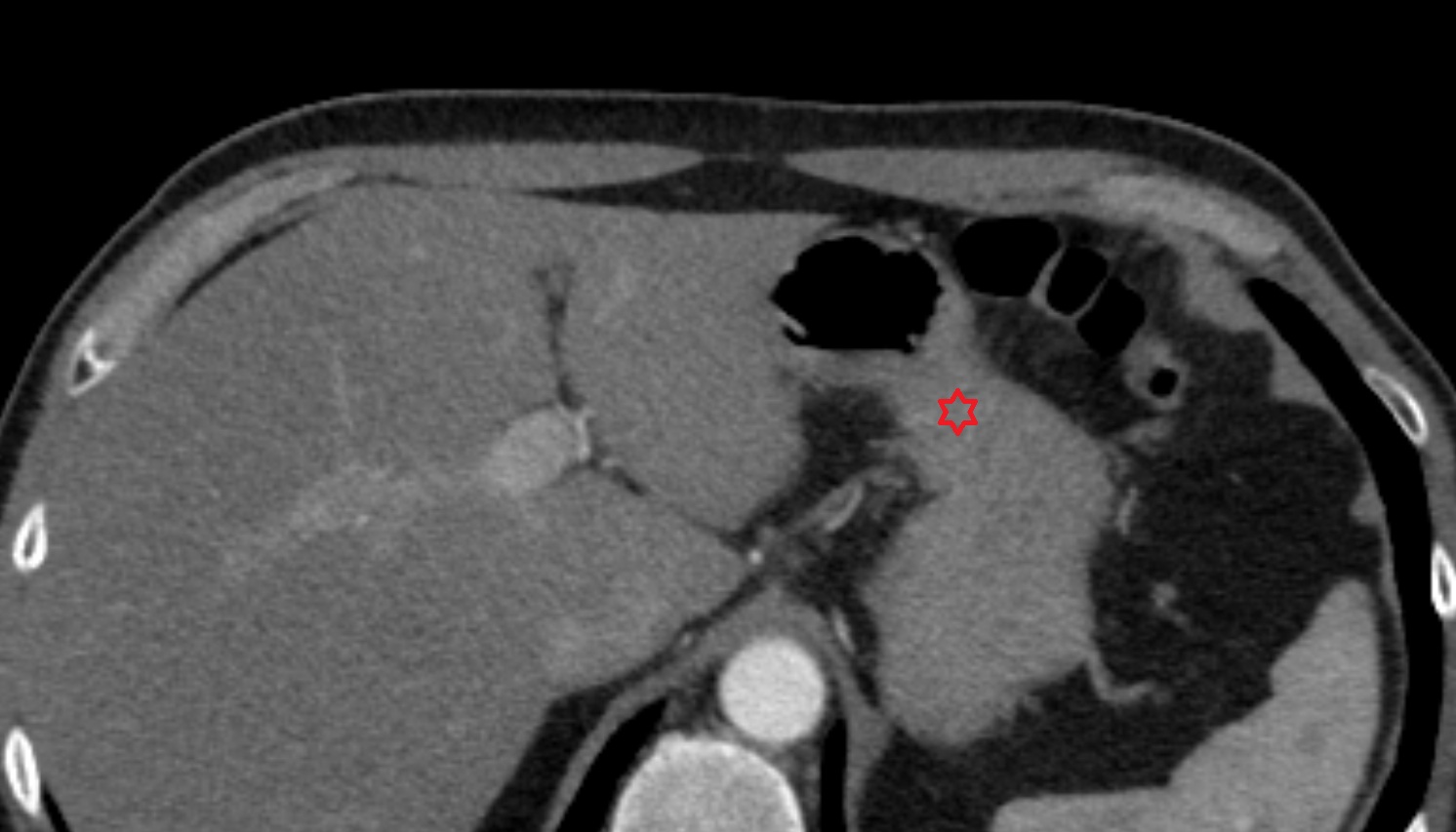 Body of stomach  anatomy CT axial  image -img-00000-00000