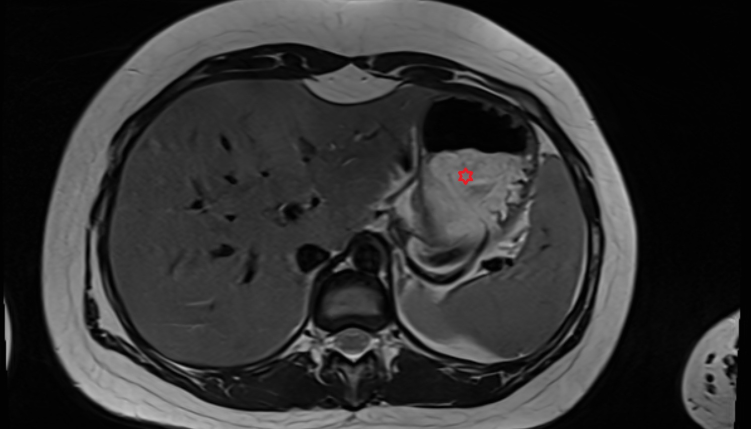 Body of stomach  anatomy  MRI  axial  image -img-00000-00000