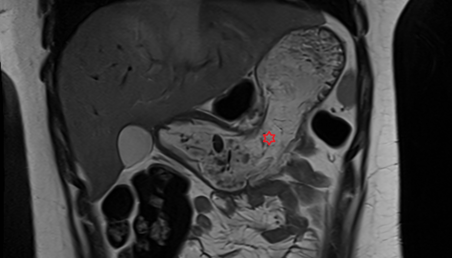 Body of stomach  anatomy  MRI  coronal  image -img-00000-00000
