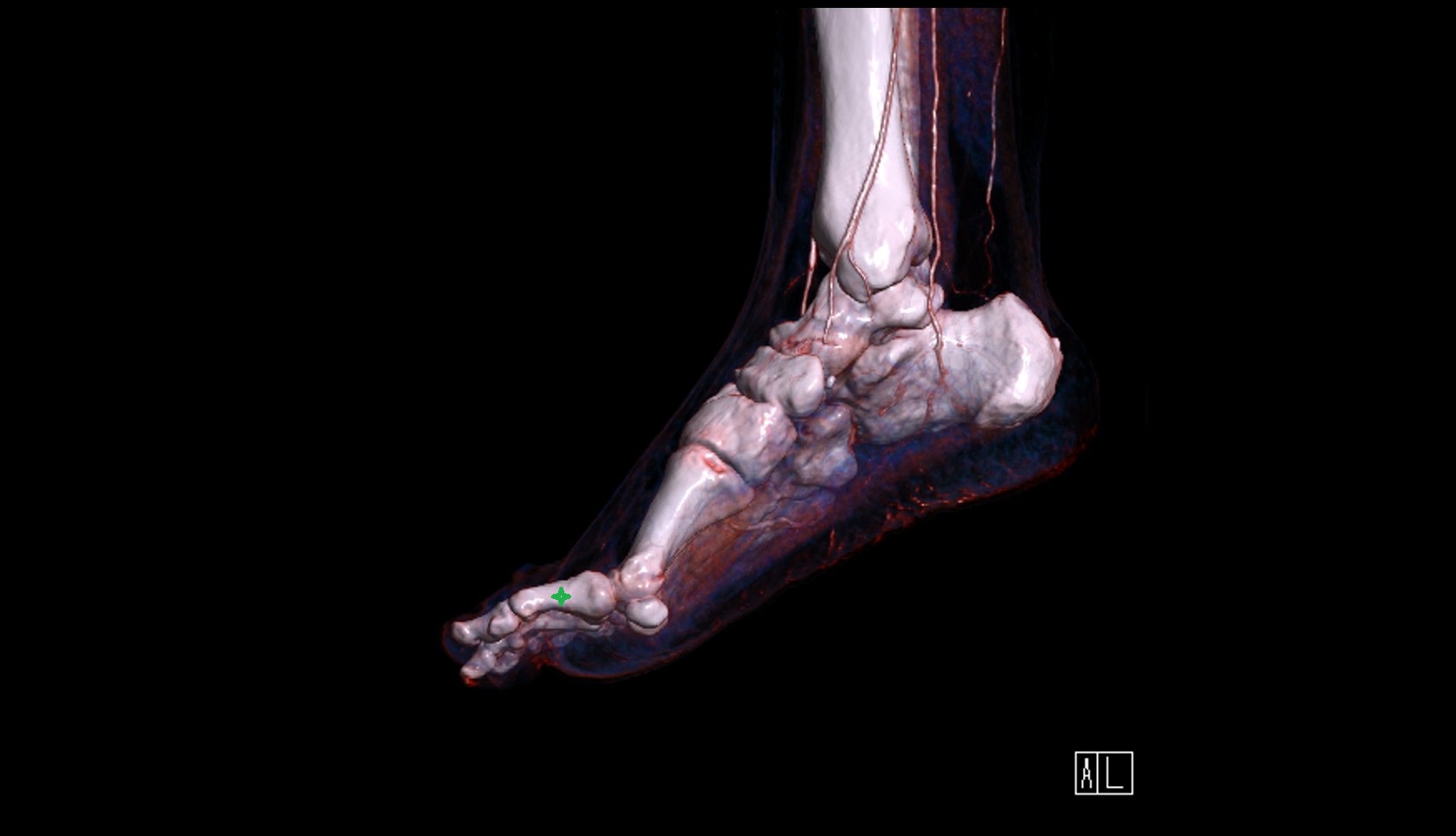 Body of the Phalanx of the Foot 3d