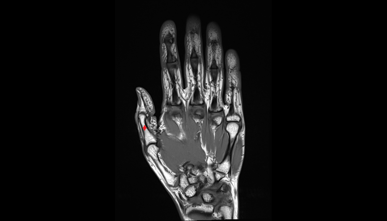 Body of the Phalanx of the Hand coronal cross sectional anatomy 3T MRI AI enhanced radiology image-img-00000-00000