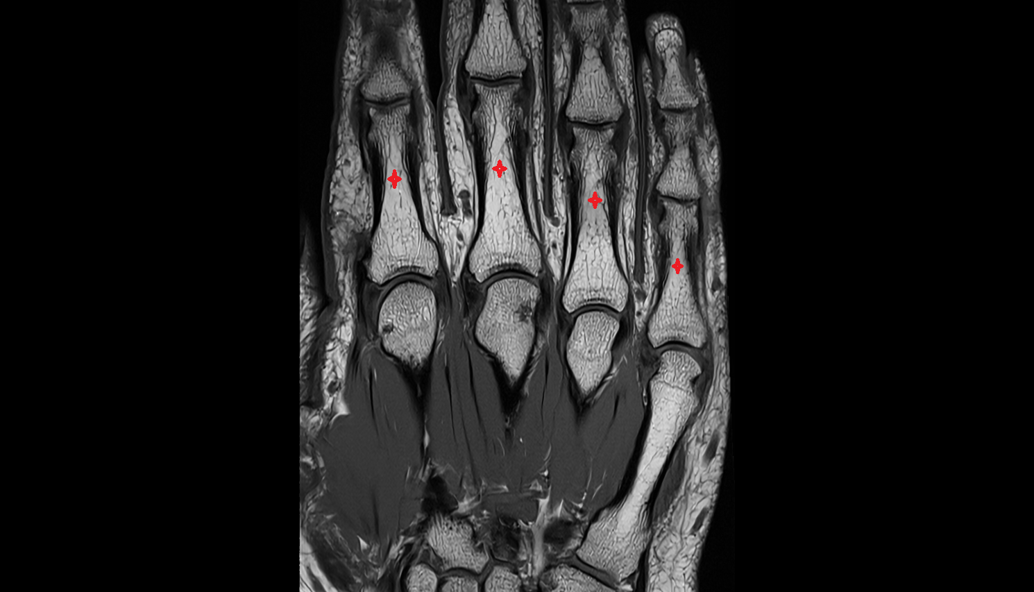 Body of the Phalanx of the Hand coronal cross sectional anatomy 3T MRI AI enhanced radiology image-img-00000-00000_00001