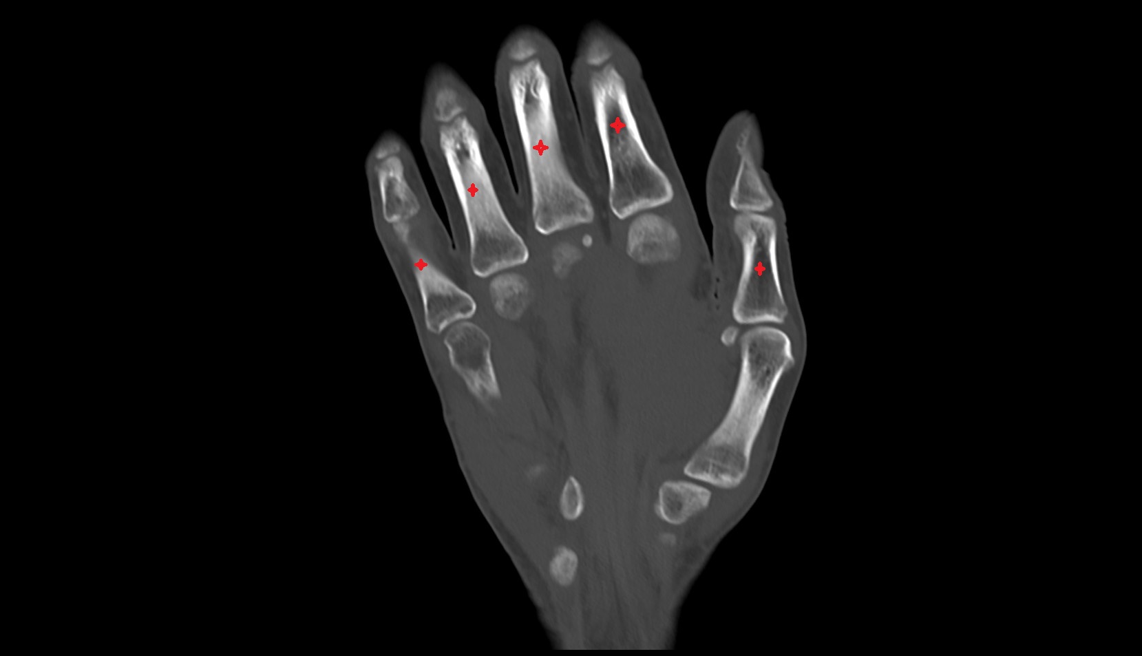 Body of the Phalanx of the Hand coronal ct image