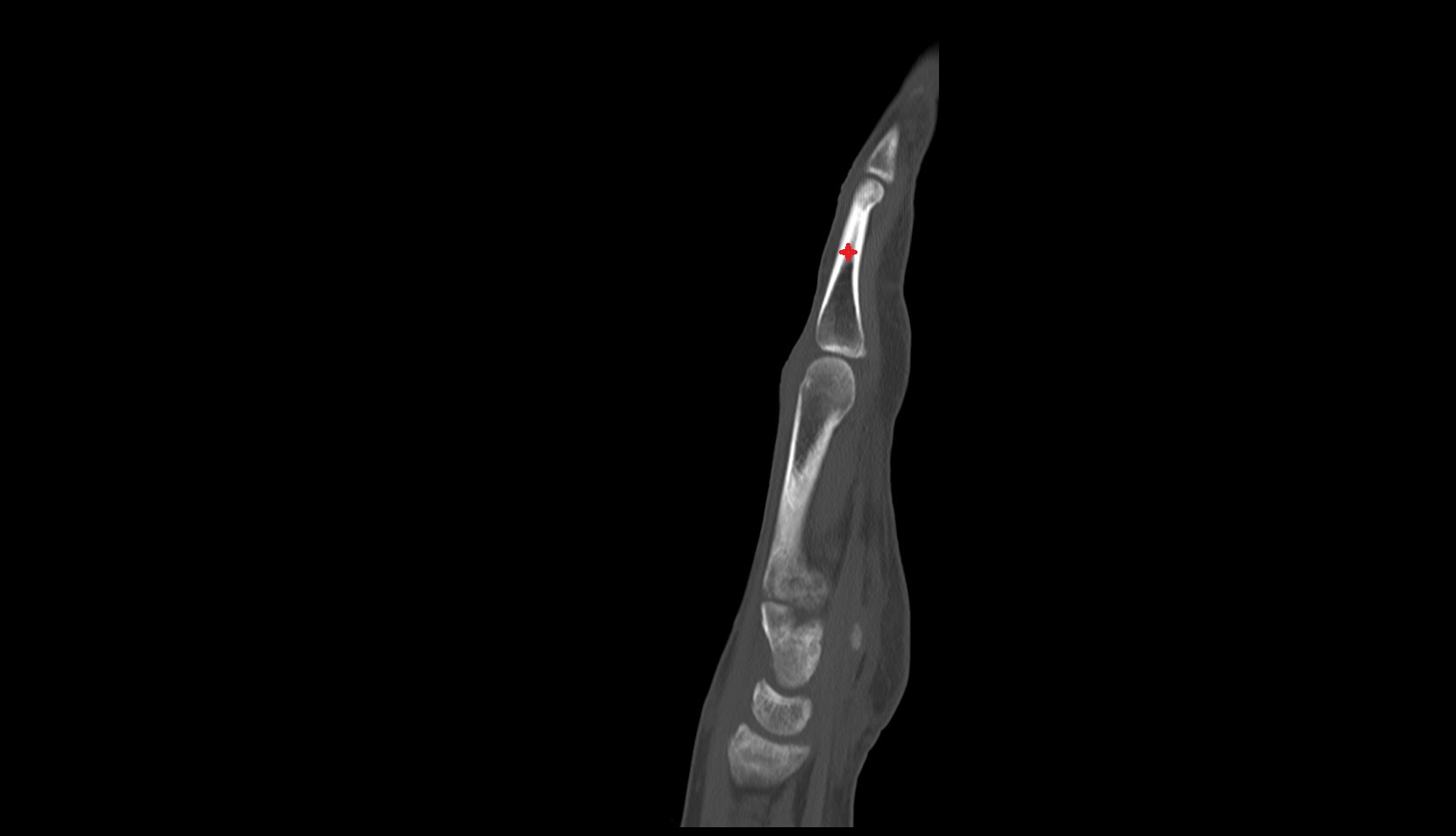 Body of the Phalanx of the Hand sag ct image