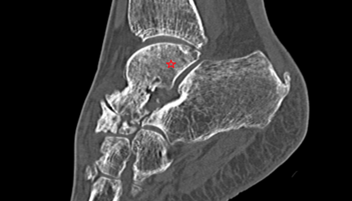 Body of the Talus CT cross sectional anatomy radiology image-img-00000-00000