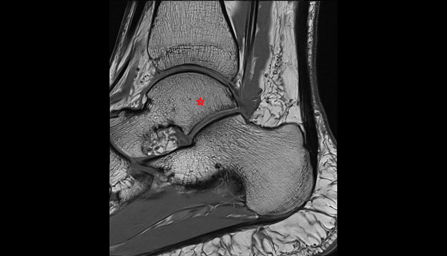 Body of the Talus sag MRI cross sectional anatomy 3T MRI AI enhanced radiology image-img-00000-00000