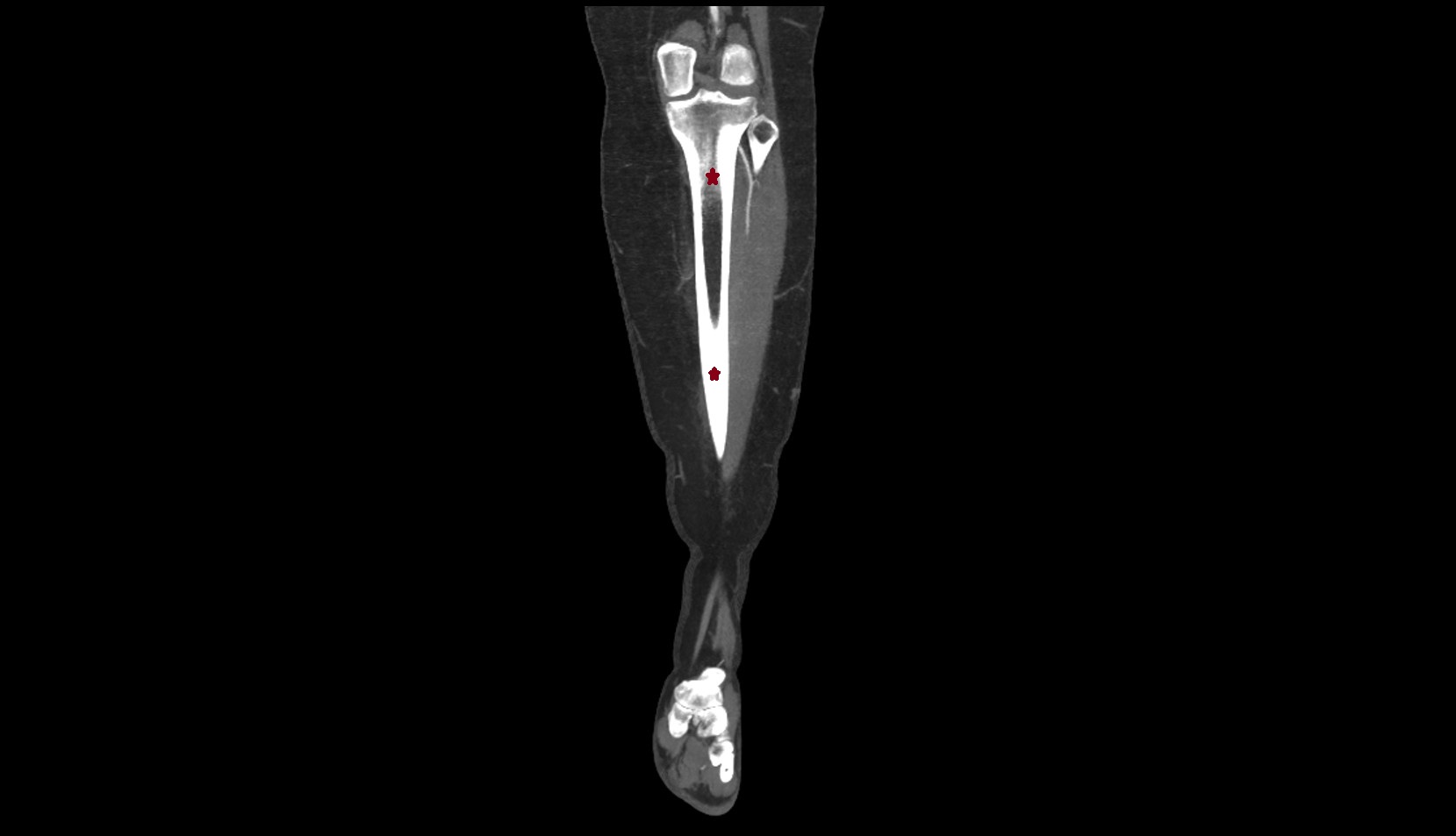 Body of tibia ct coronal image