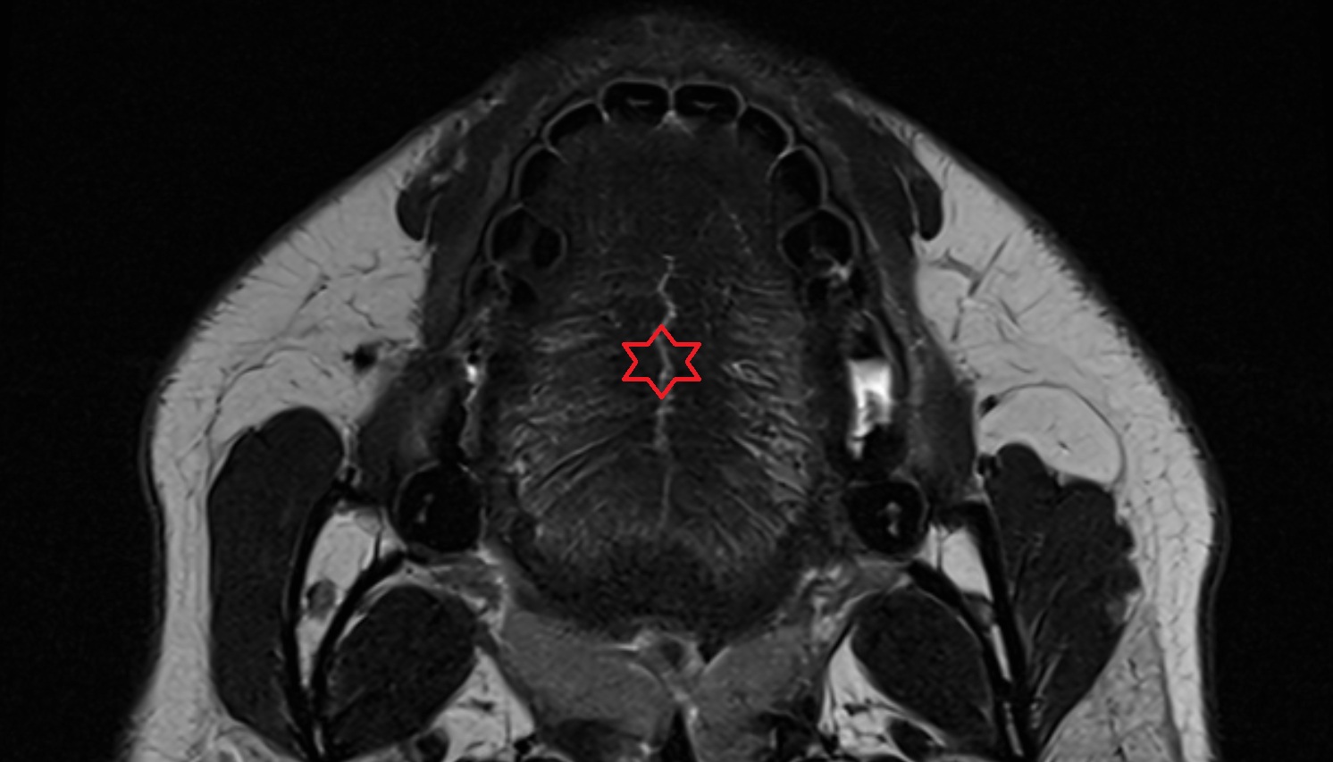 Body of tongue mri axial  image -img-00000-00000