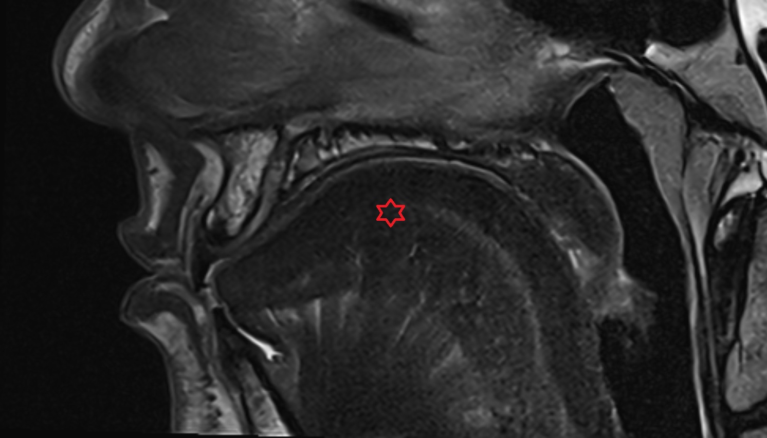 Body of tongue mri sagittal  image -img-00000-00000