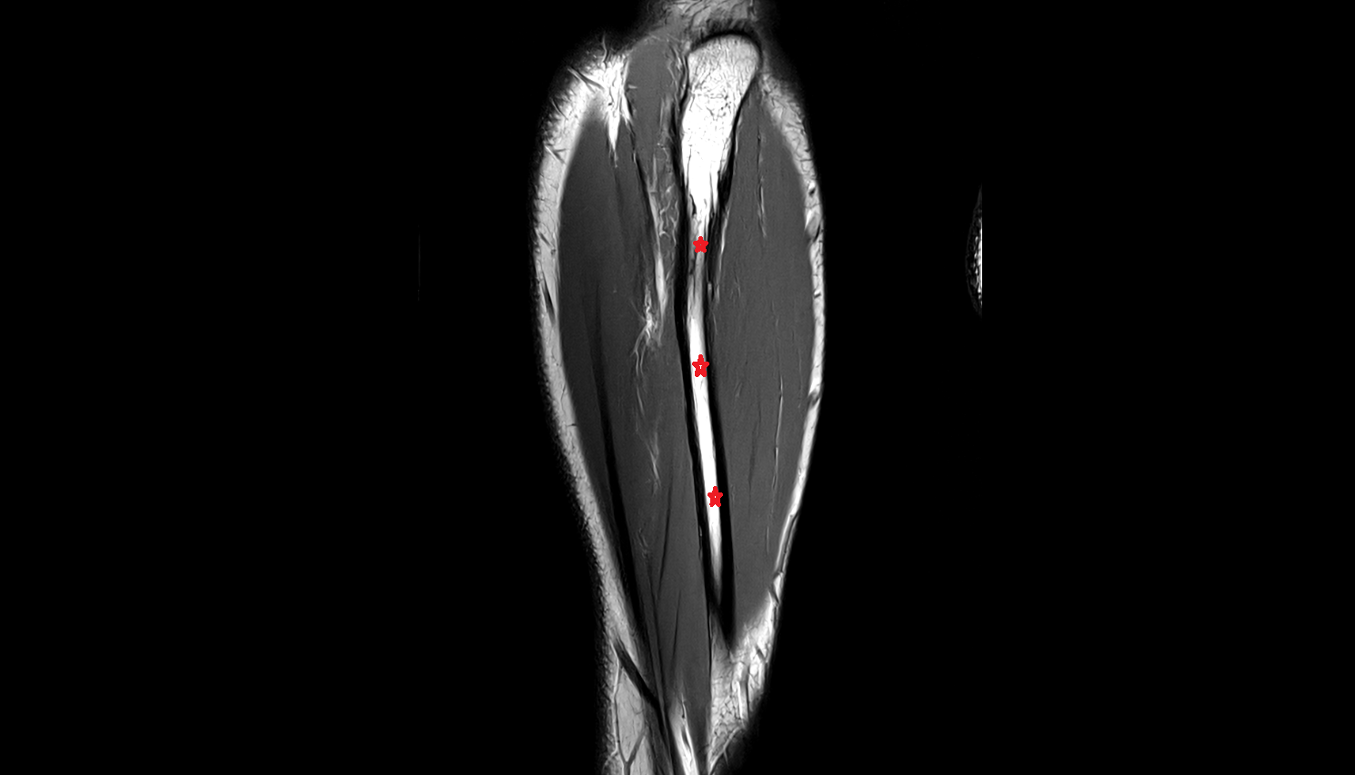Body of ulna  mri  anatomy labelled image-img-00000-00000