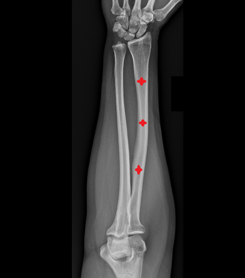 Body of ulna  x ray  anatomy labelled image-img-00000-00000
