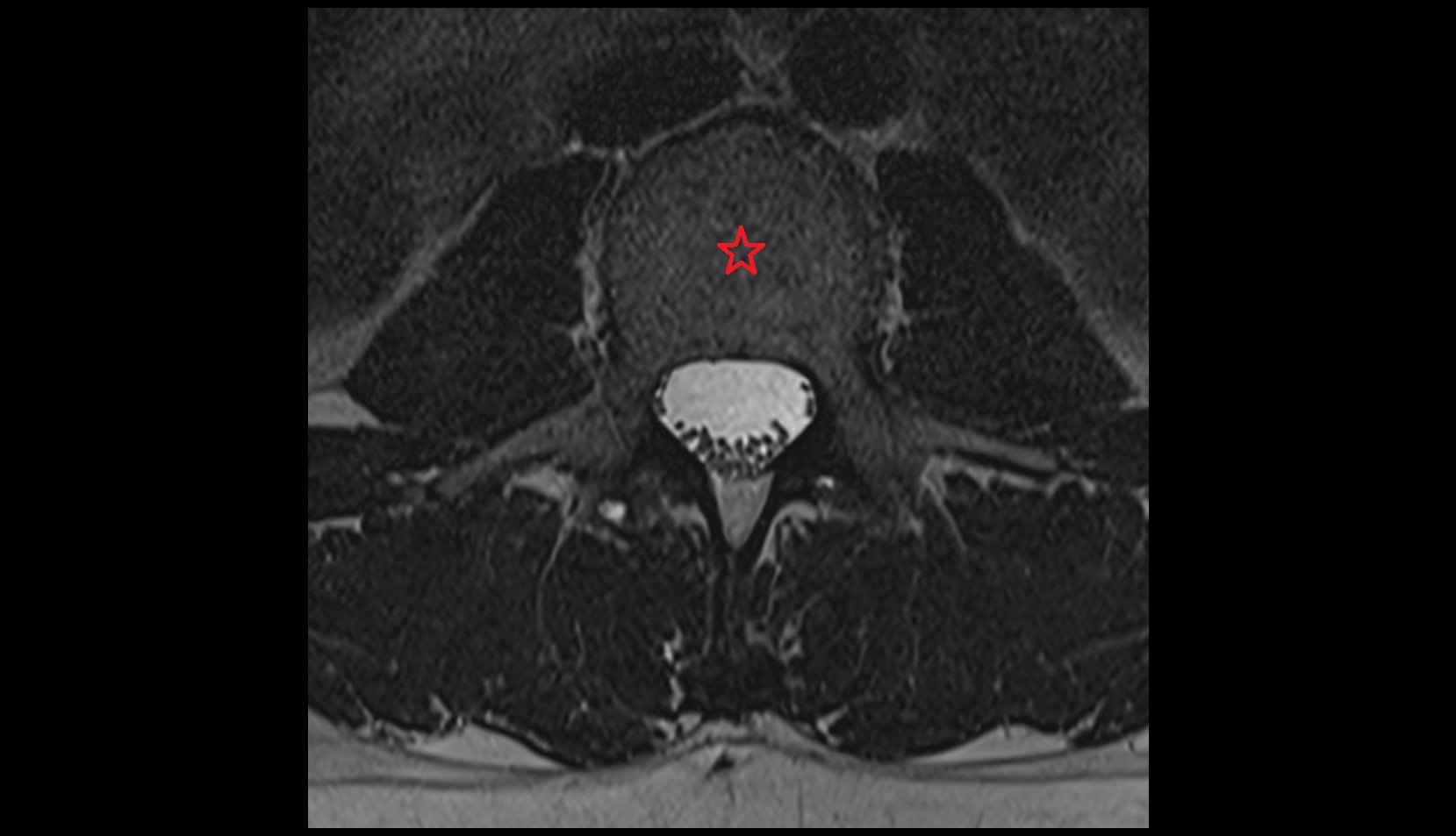 Body of vertebra mri axial image