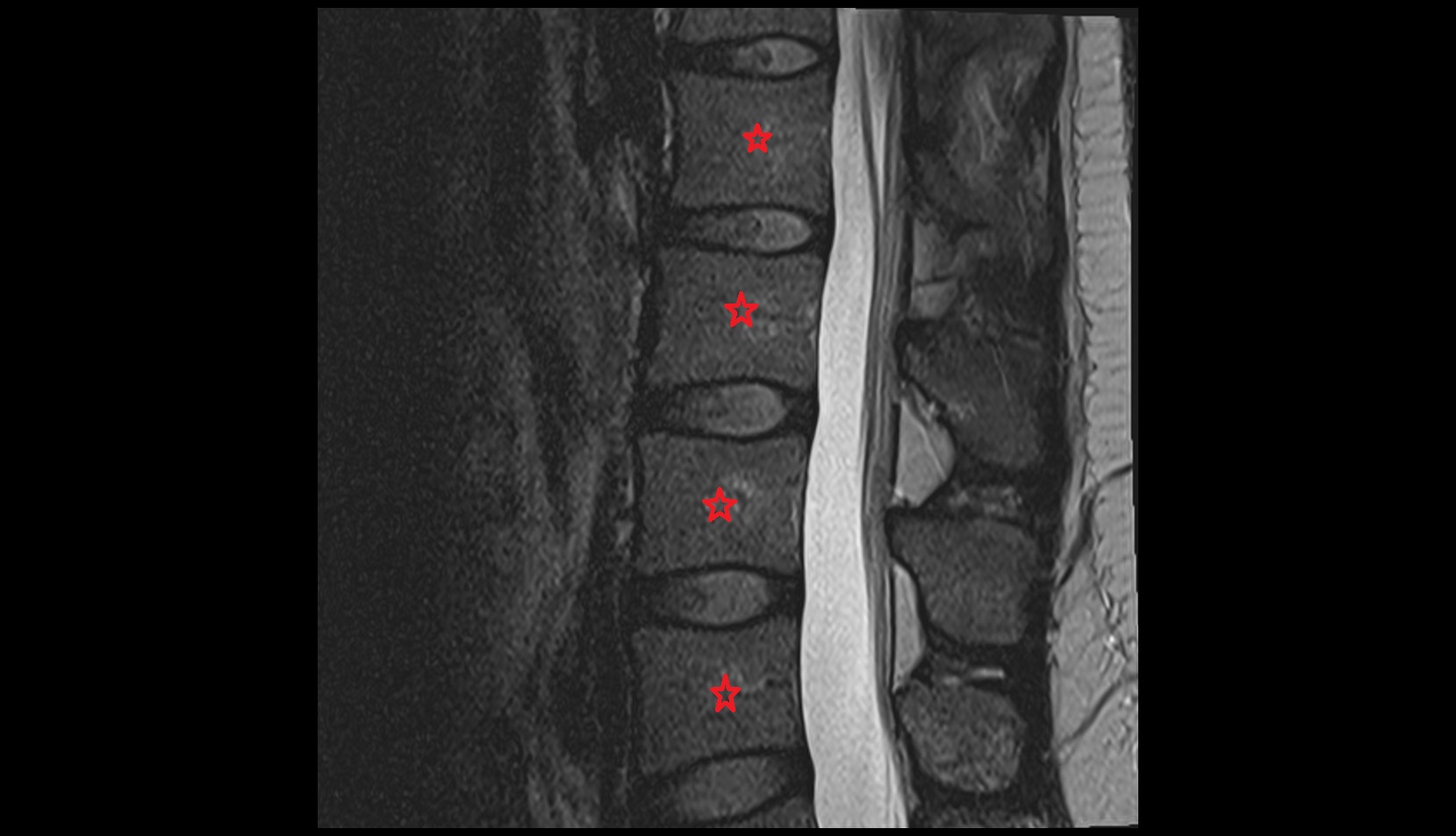 Body of vertebra mri l spine  sag image
