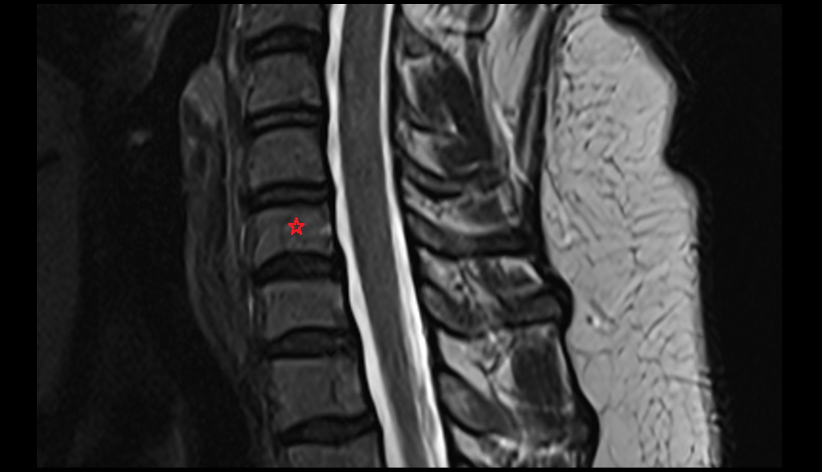 Body of vertebra mri sag image