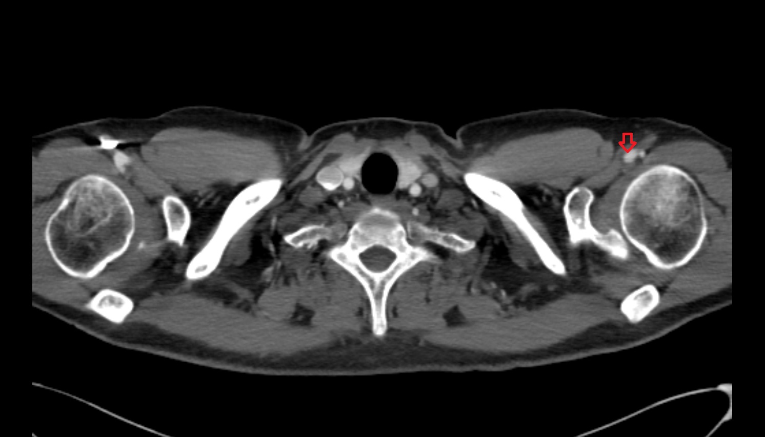 Brachial artery CT axial  image -img-00000-00000
