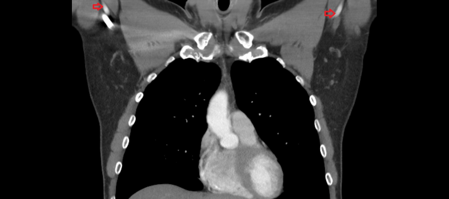 Brachial artery CT coronal  image -img-00000-00000