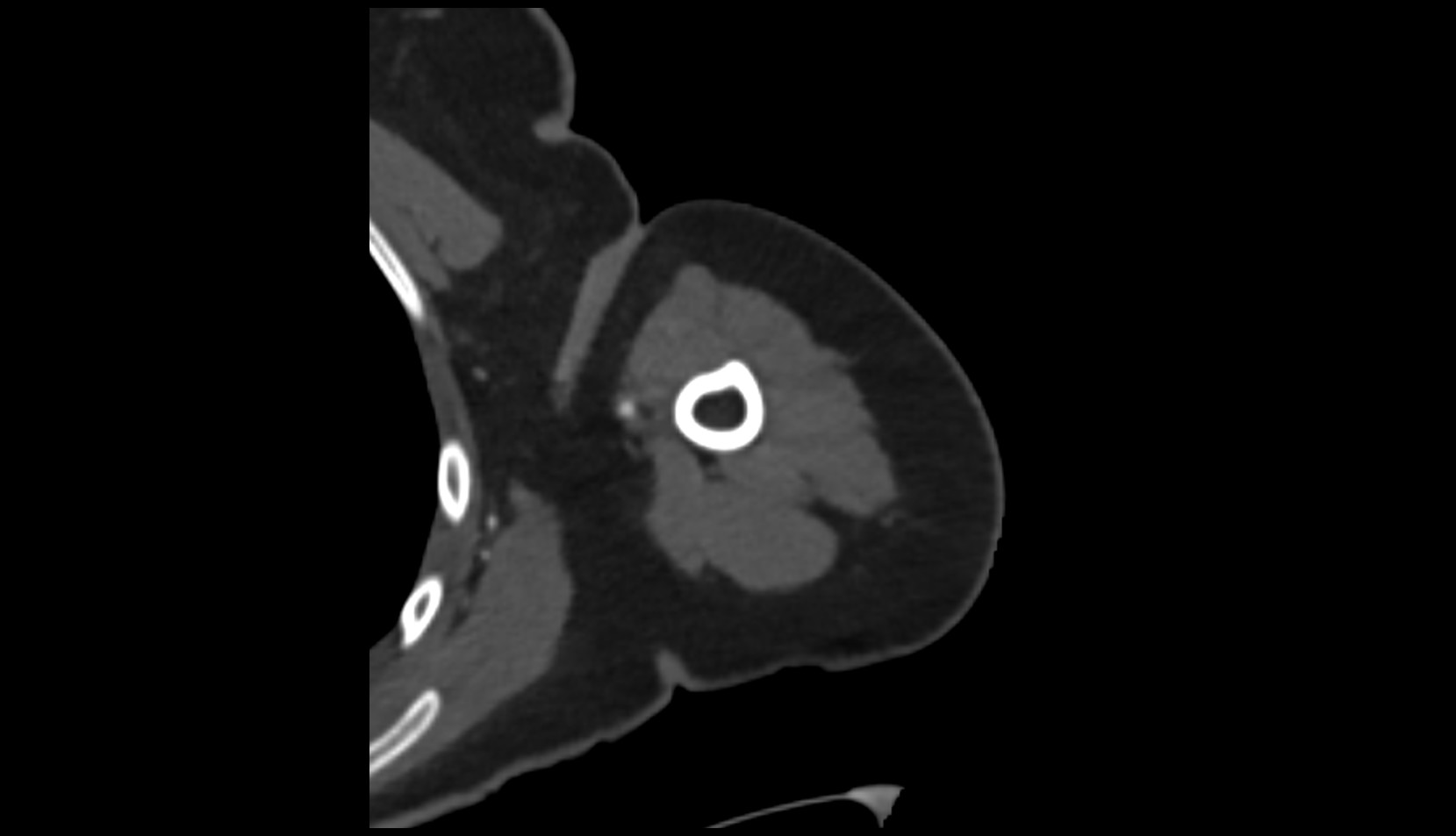 Brachial artery ct axial