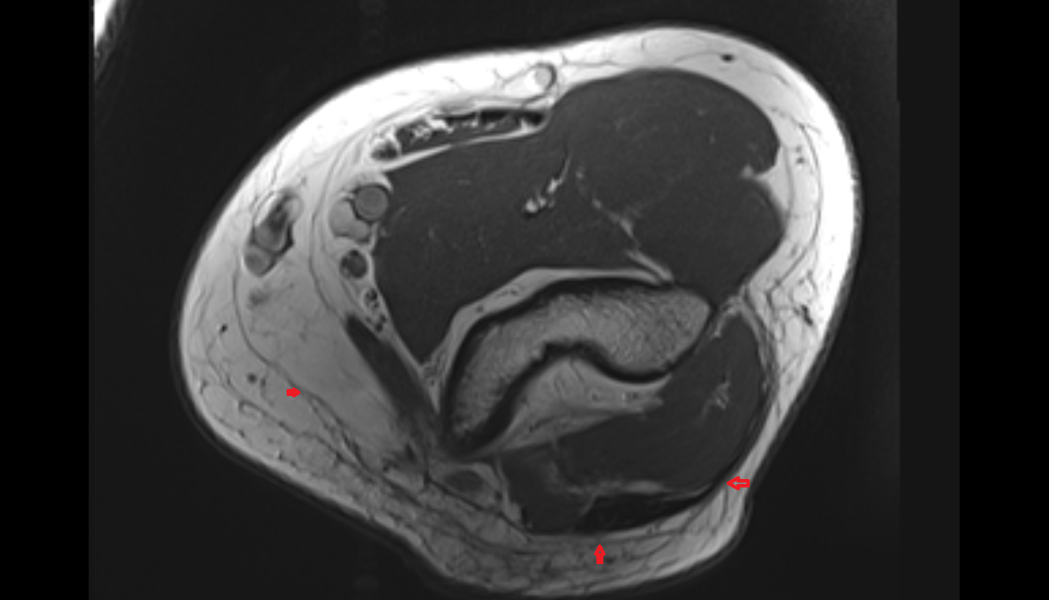 Brachial fascia axial cross sectional anatomy 3T MRI AI enhanced radiology image -img-00000-00000