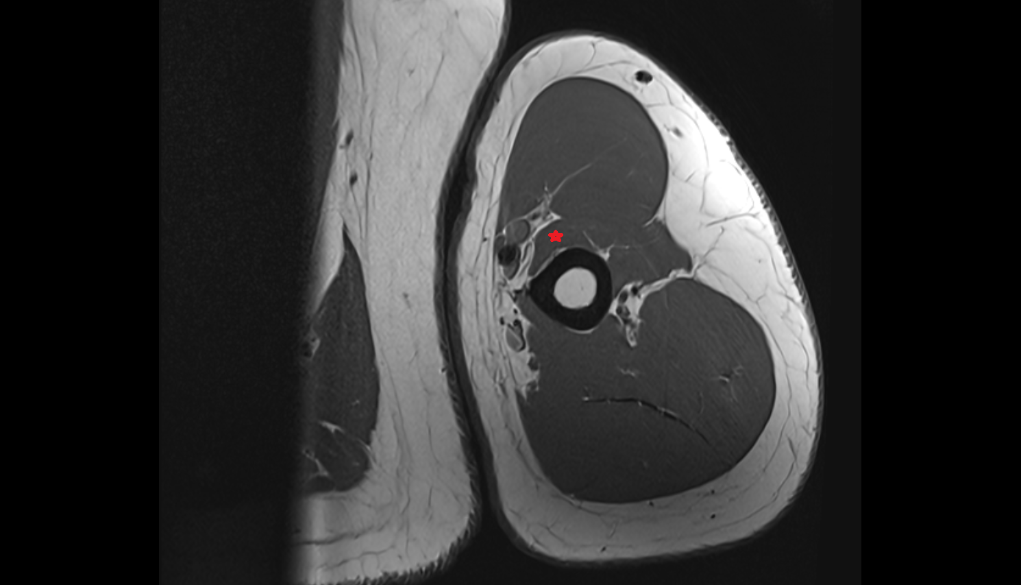 Brachialis muscle  axial cross sectional anatomy 3T MRI AI enhanced radiology image -img-00000-00000