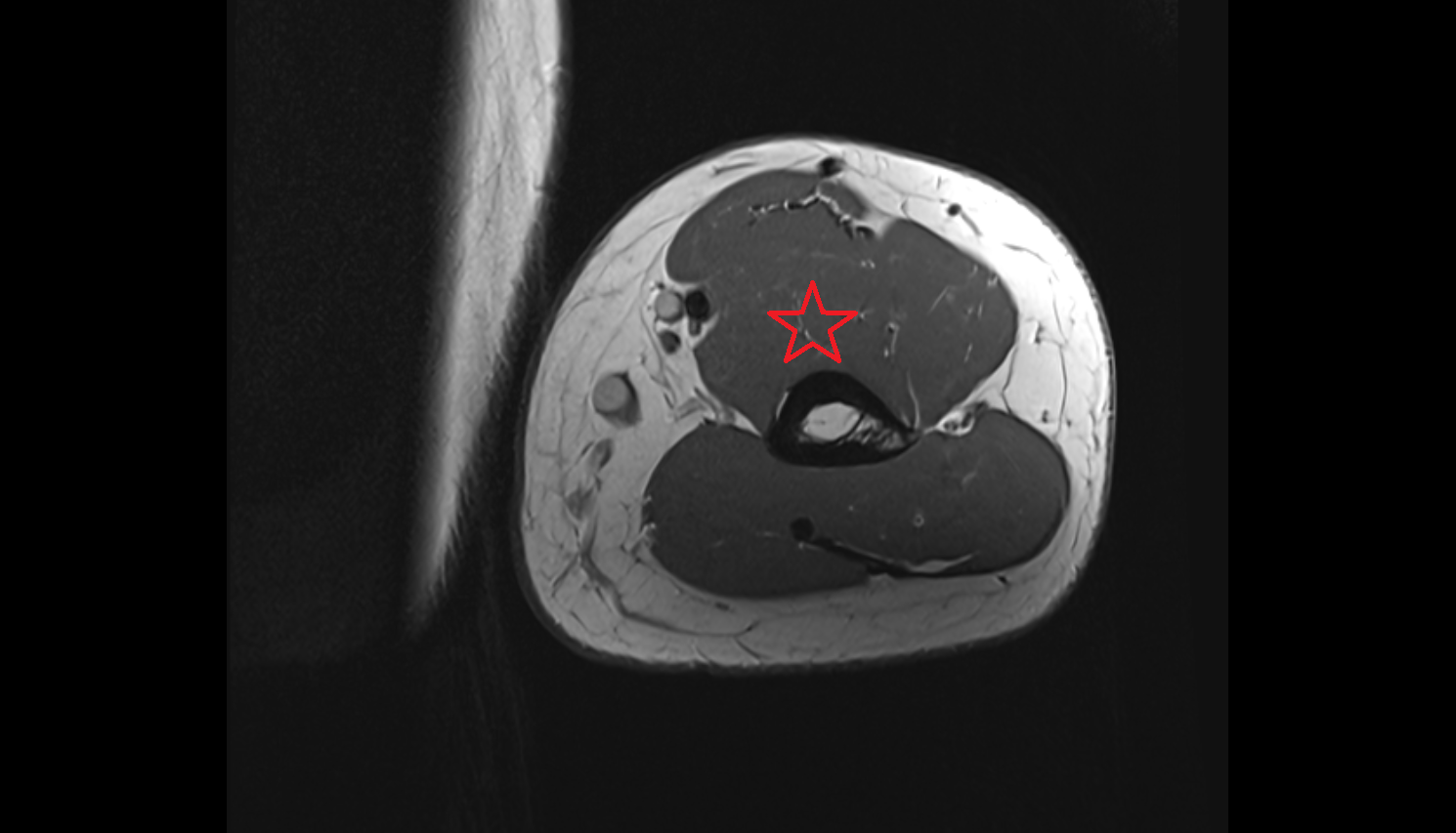 Brachialis muscle  axial cross sectional anatomy 3T MRI AI enhanced radiology image -img-00000-00000_00001