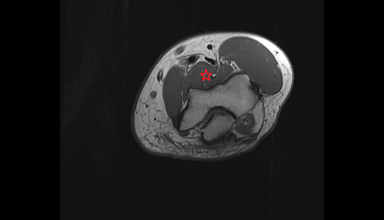 Brachialis muscle  axial cross sectional anatomy 3T MRI AI enhanced radiology image -img-00000-00000_00002