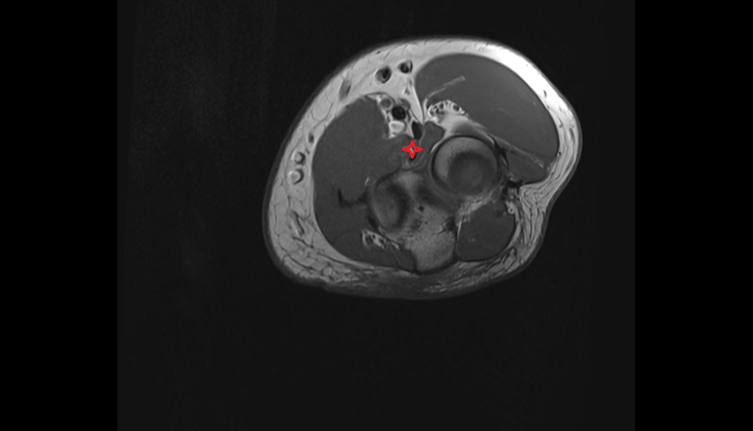 Brachialis muscle  axial cross sectional anatomy 3T MRI AI enhanced radiology image -img-00000-00000_00003