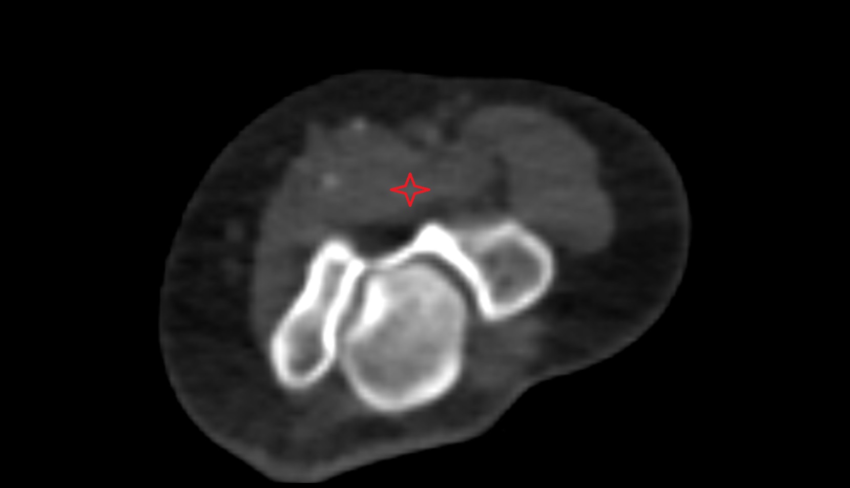 Brachialis muscle ct axial