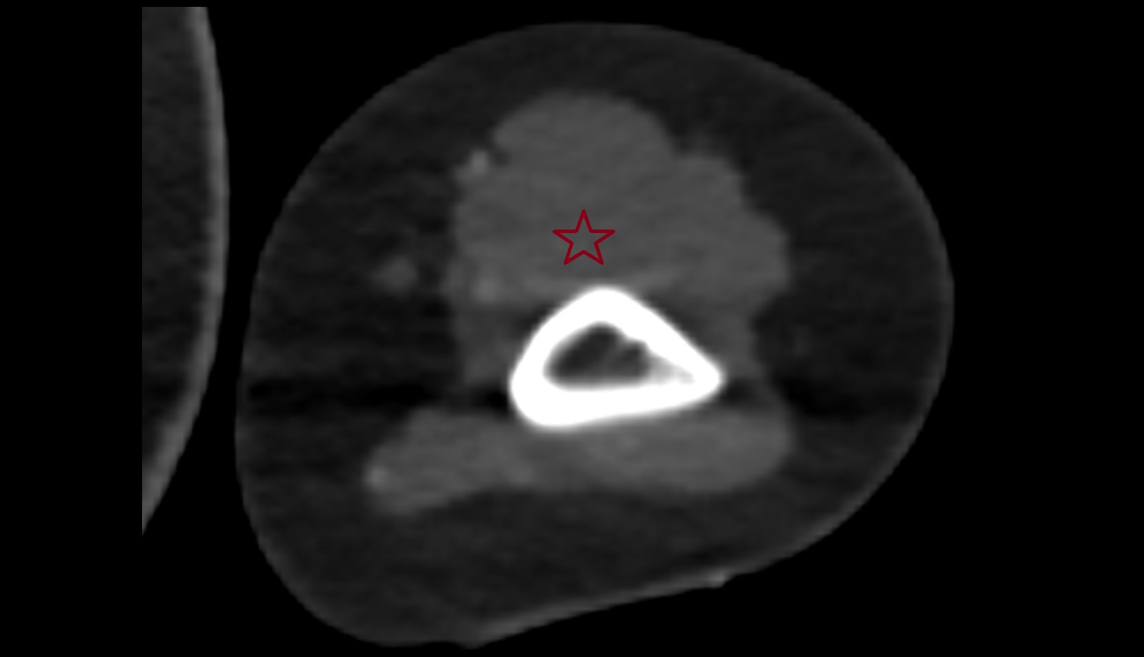Brachialis muscle ct axial image