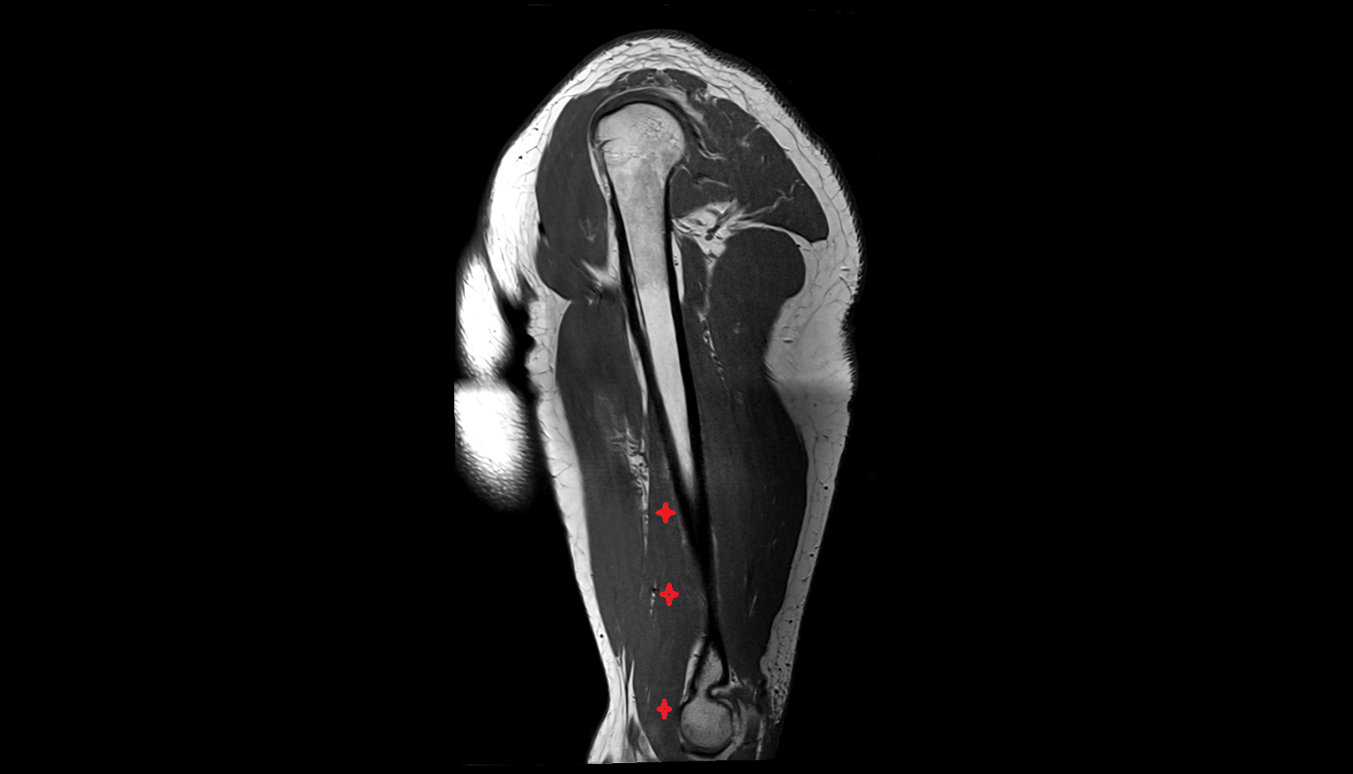 Brachialis muscle  sag cross sectional anatomy 3T MRI AI enhanced radiology image -img-00000-00000_00004