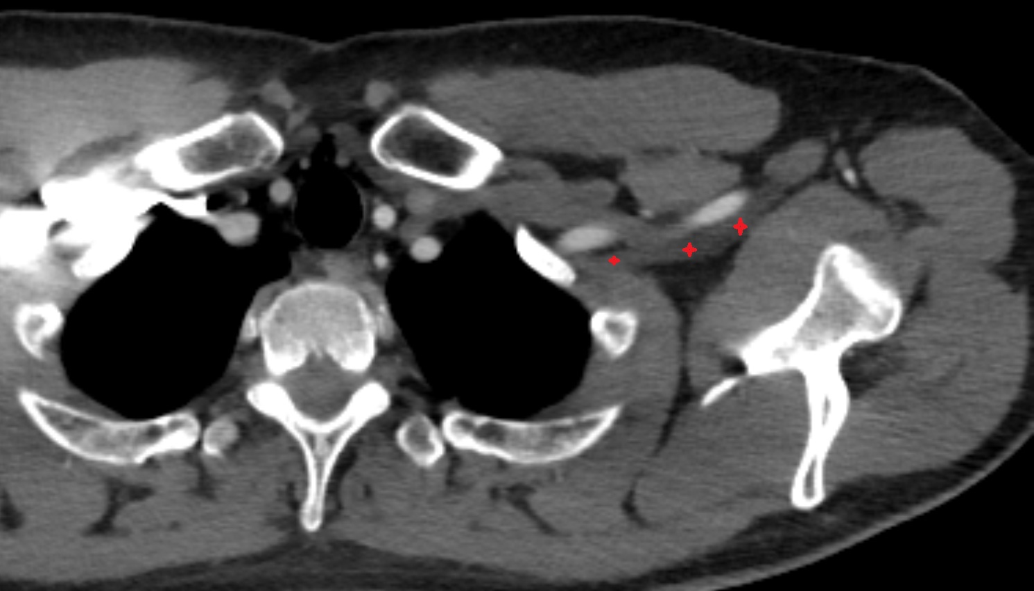 Brachial plexus  anatomy  CT axial  image -img-00000-00000_00001