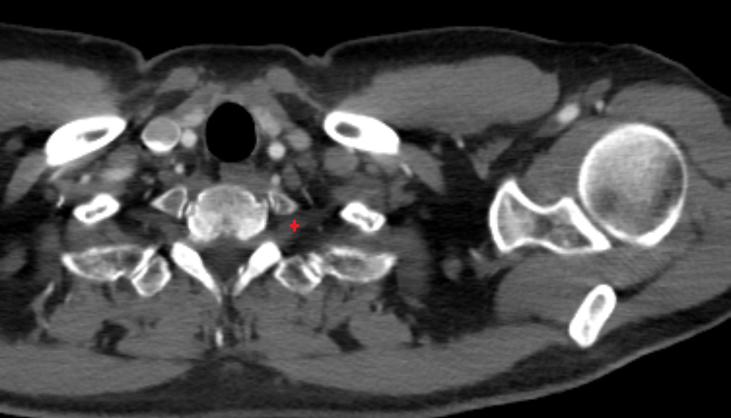 Brachial plexus  anatomy  CT  axial image