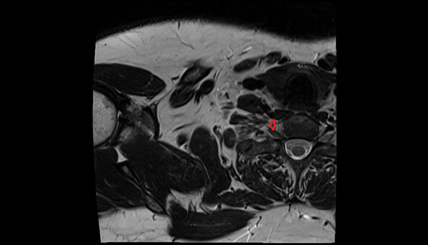 Brachial plexus  anatomy MRI axial  image -img-00000-00000
