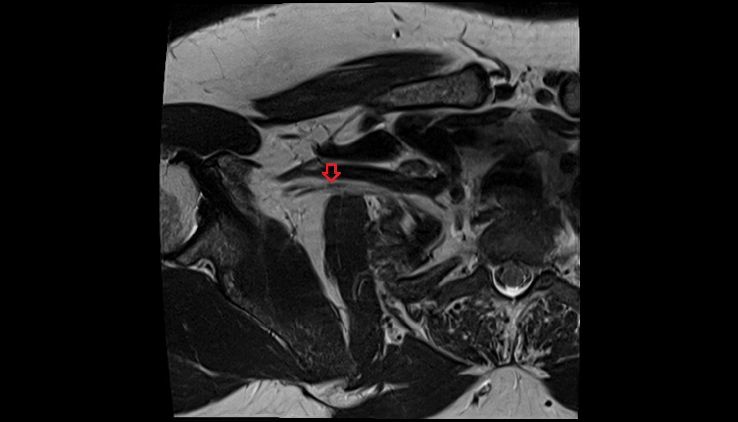 Brachial plexus  anatomy MRI axial  image -img-00000-00000_00001